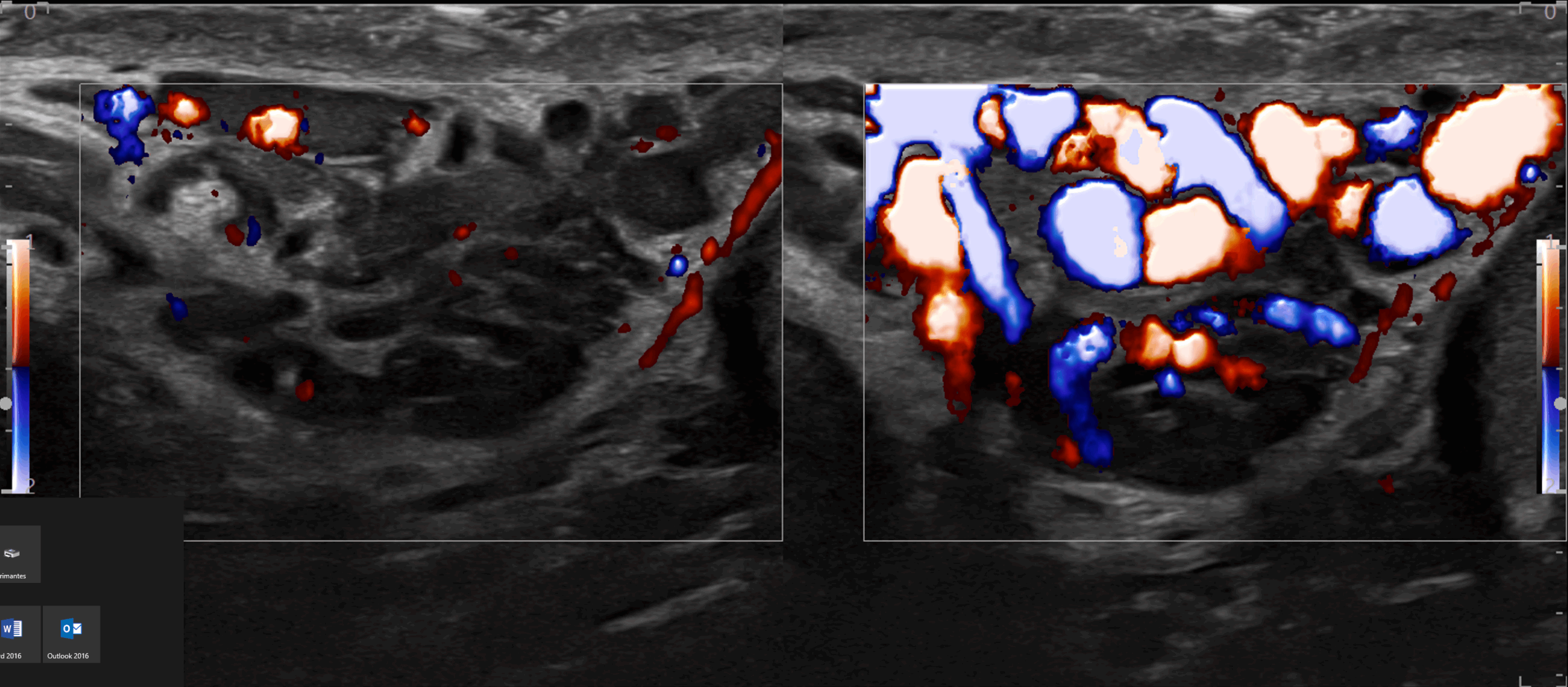 Echographie Doppler d'une varicocèle