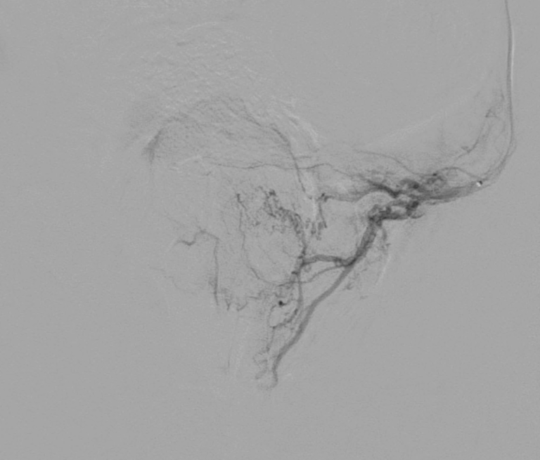 Angiographie des artères prostatiques