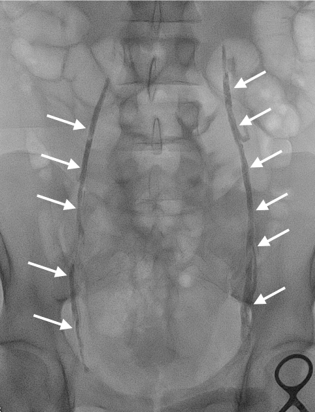 Radiographie après embolisation de varicocèle bilatérale