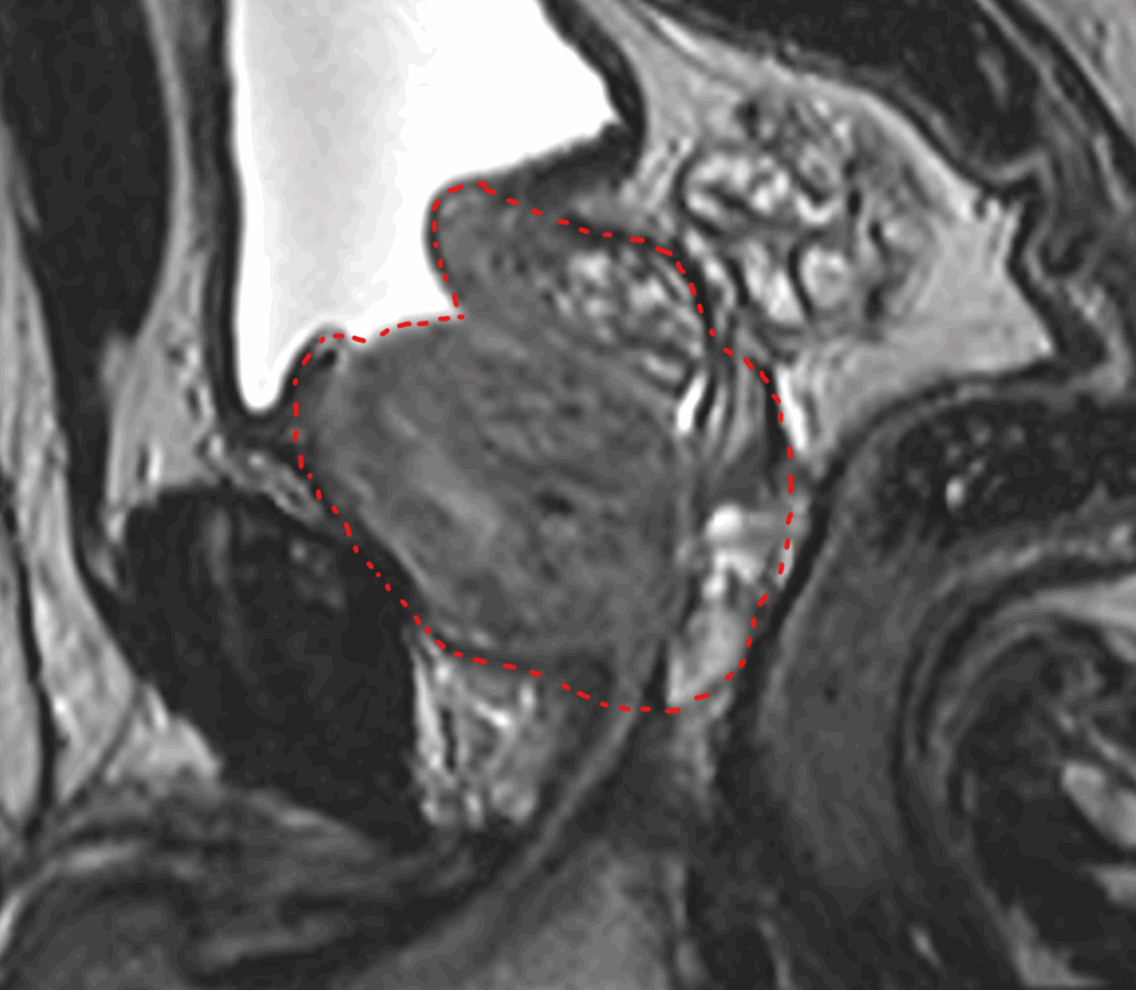 IRM de prostate