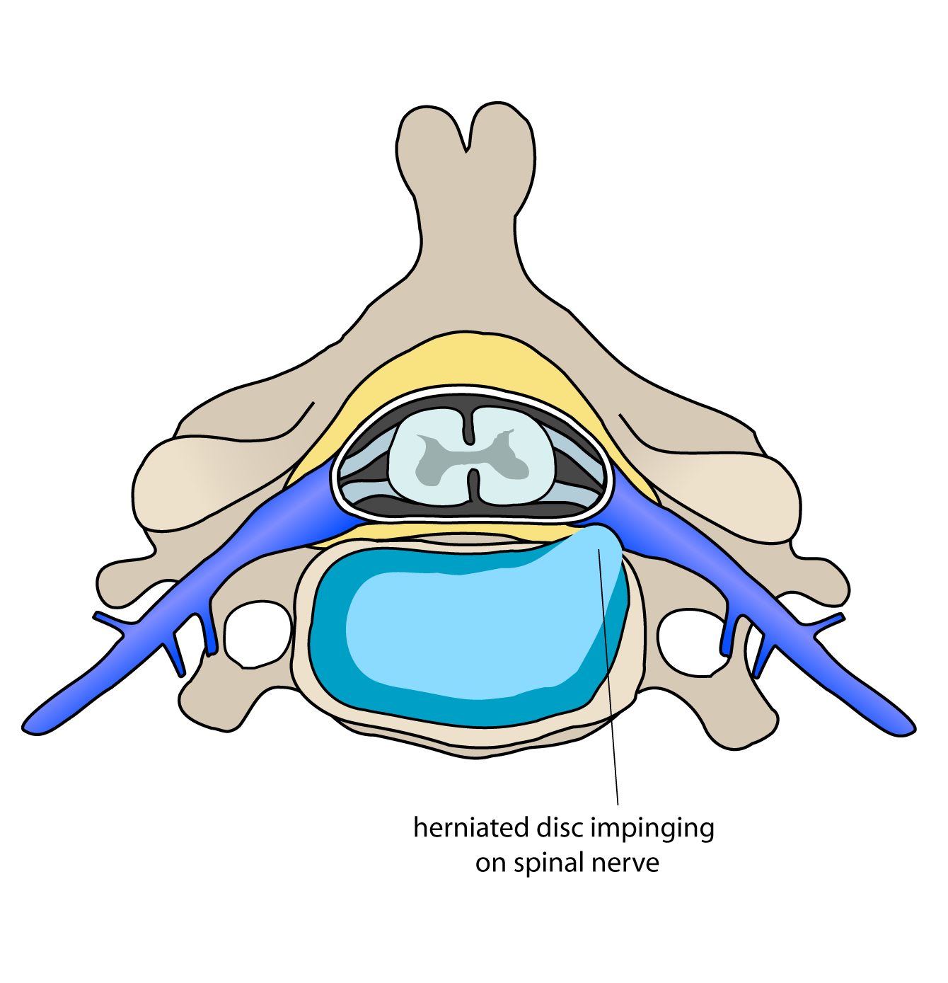Illustration d'un disque intervertébral siège d'une hernie discale