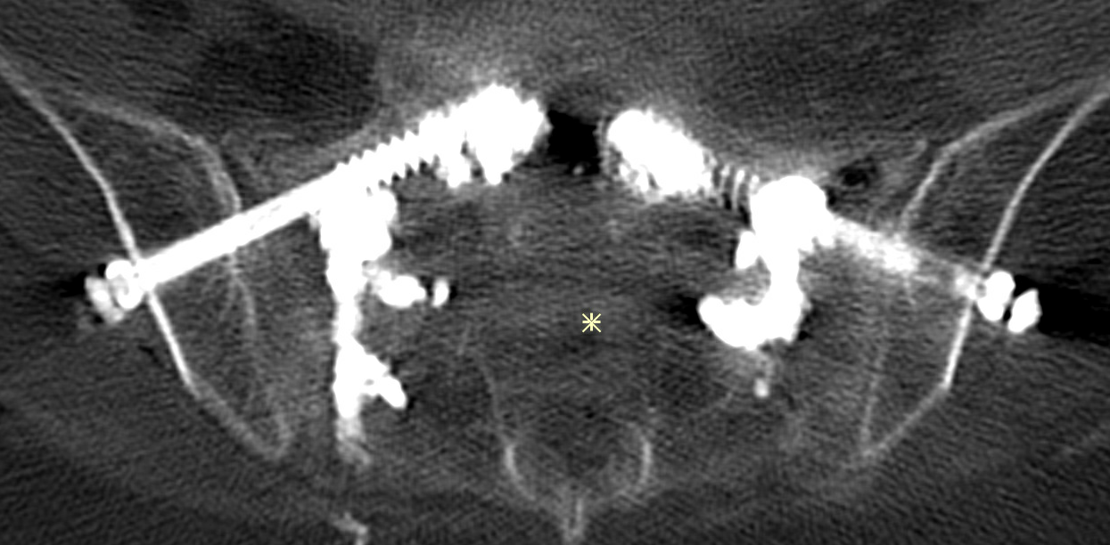 Scanner après vissage bilatéral et cimentoplastie du sacrum. Les vis réalisent un pont allant d'os sain à os sain, en passant par les traits de fractures. Du ciment est rajouté pour renforcer le montage.