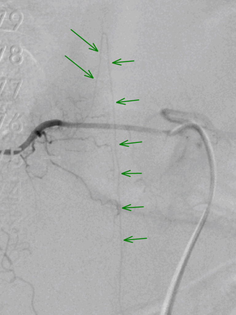 Angiographie médullaire