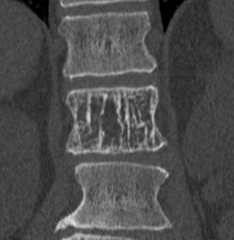 Scanner montrant un hémangiome vertébral