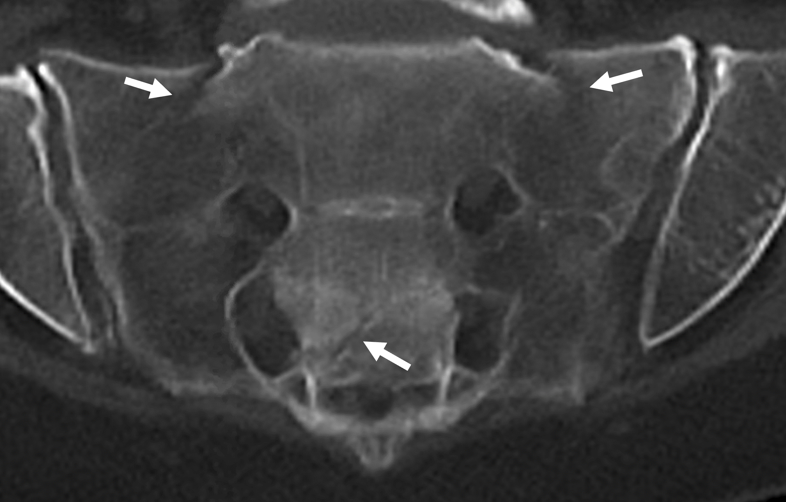 Scanner montrant une fracture du sacrum